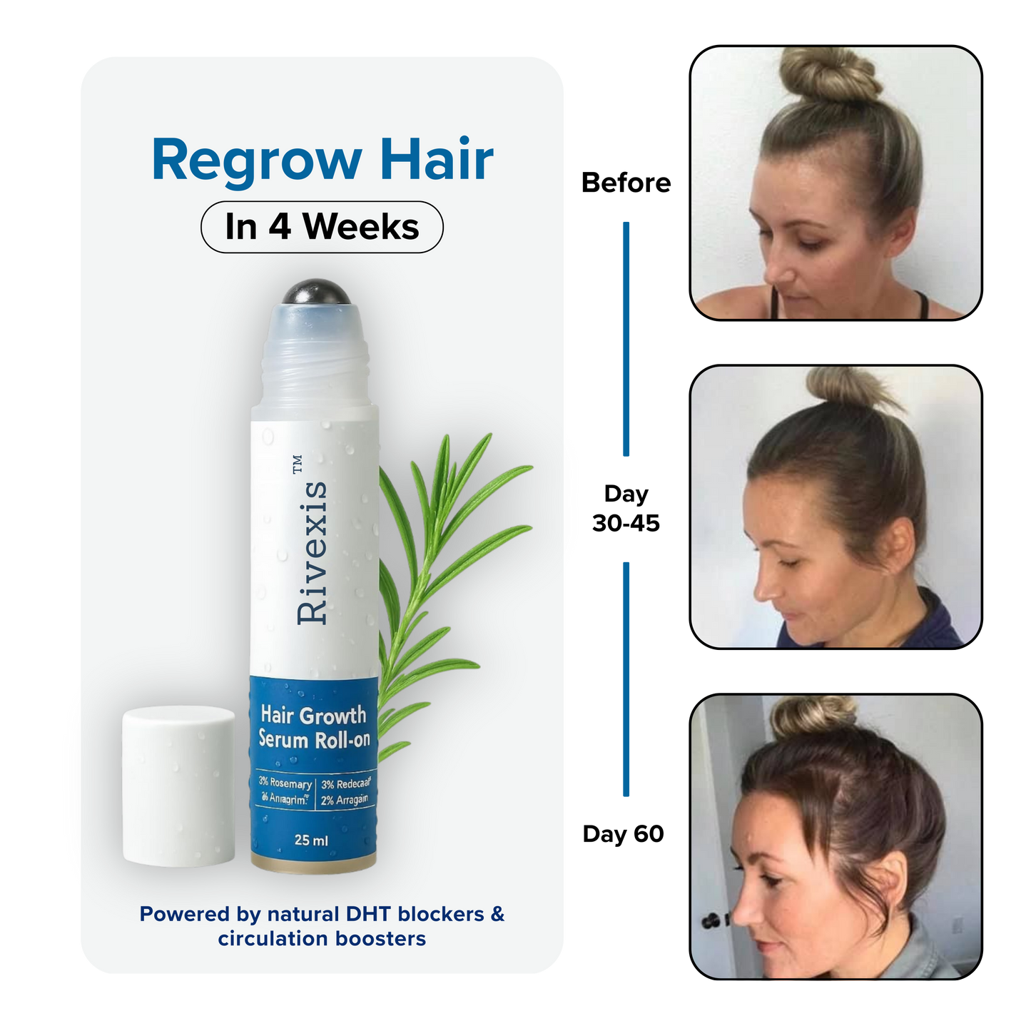 Rivexis™ Hair Regrowth System