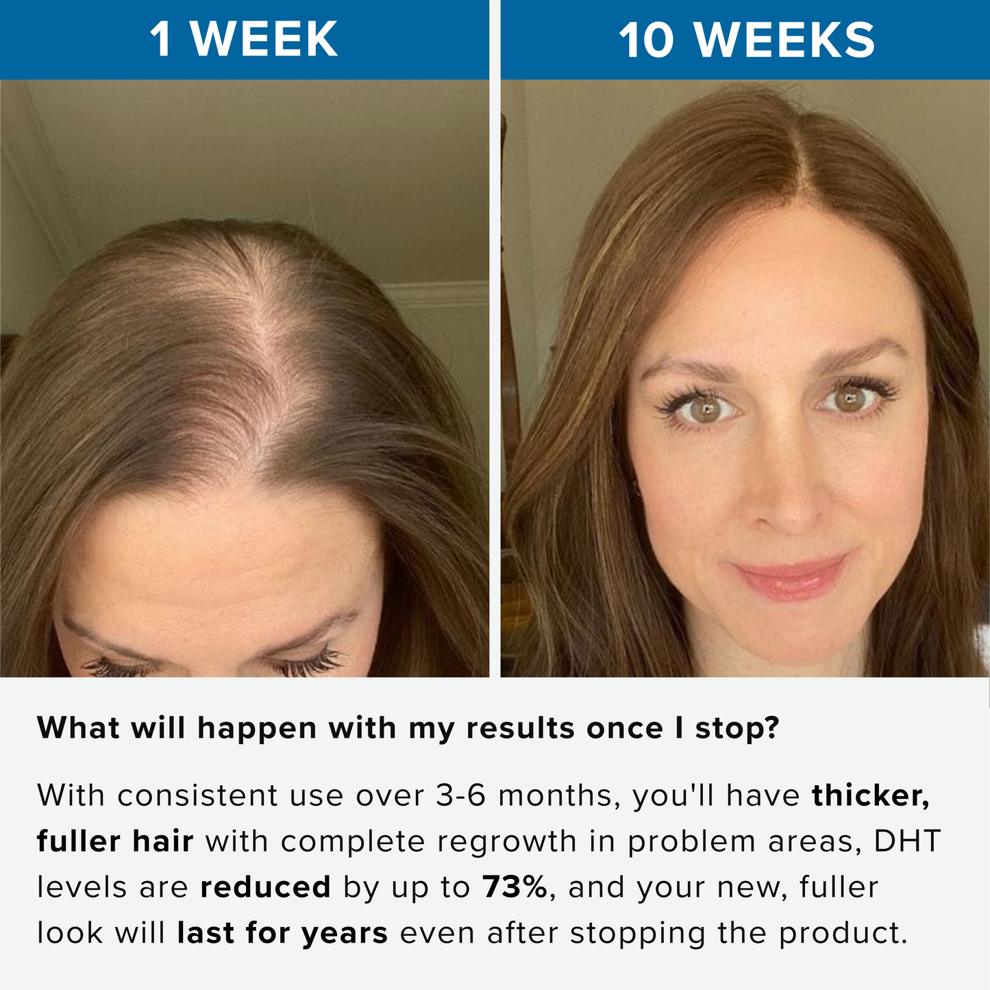 Rivexis™ Hair Regrowth System