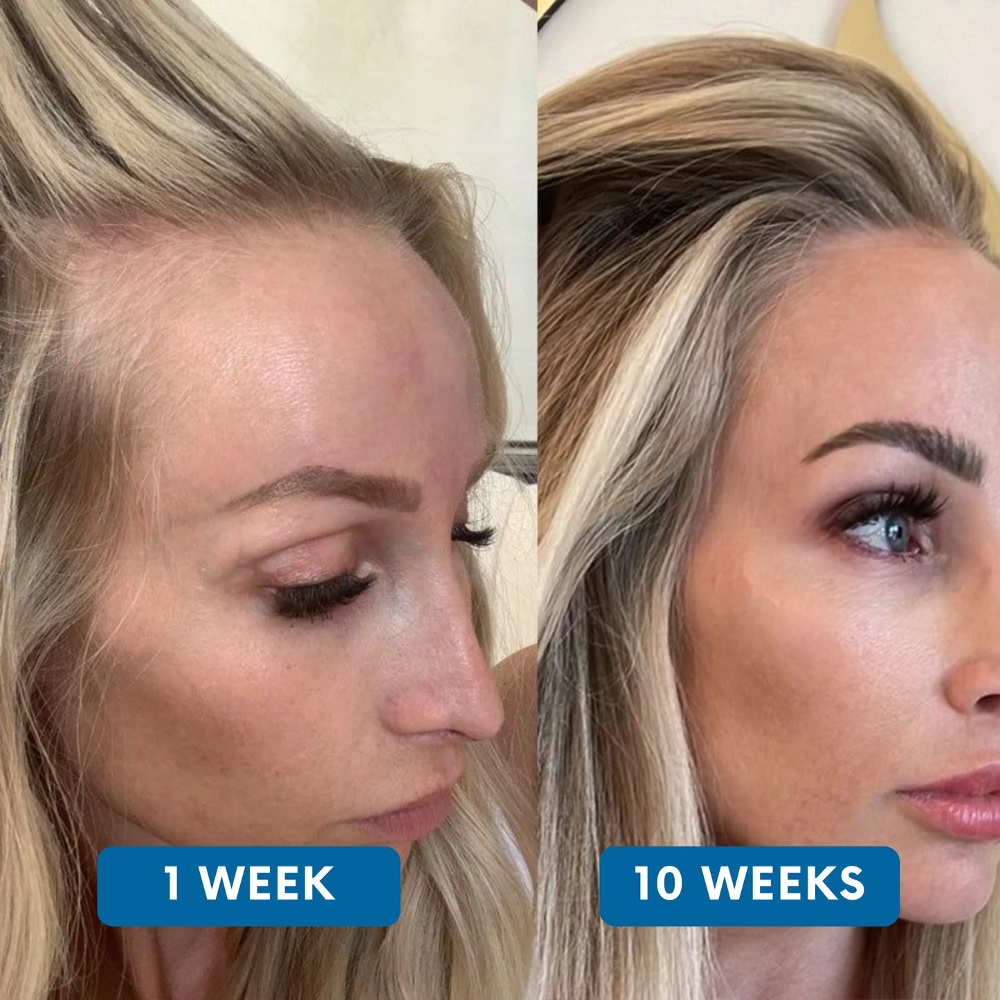 Rivexis™ Hair Regrowth System